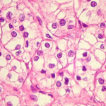 Carcinoma de Células Claras